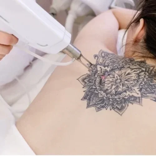 tatoo-removal-transformed