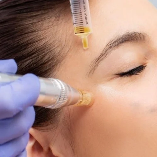 Microneedling (2)