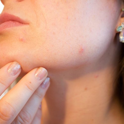 acne, pores, skin-1606765.jpg