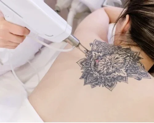 tatoo-removal-transformed